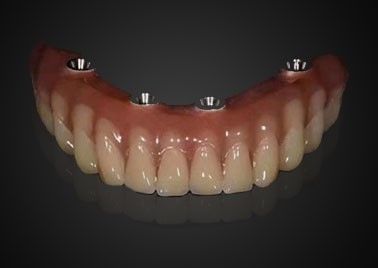comprare Impianto dentale di sostituzione personalizzato Corona resistente all'usura per l'uso a lungo termine fabbricazione online