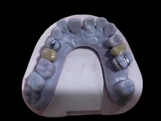 comprare Corone dentali PFM ad alta precisione in lega di Ni corone di porcellana in metallo libero fabbricazione online