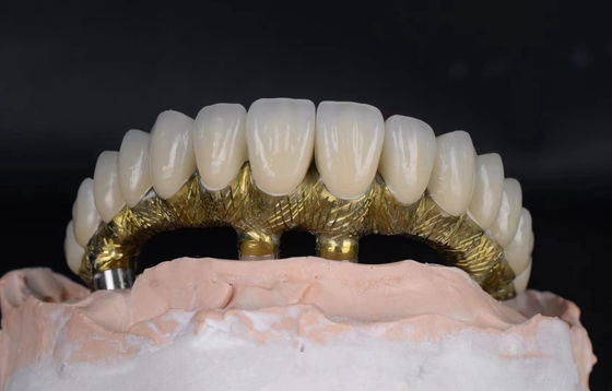 comprare Impianti dentali e corone in lega di titanio dall' aspetto naturale e resistenti alla corrosione fabbricazione online