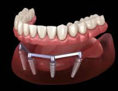 comprare Bar di impianto dentale sabbiato per estetica traslucida e naturale fabbricazione online
