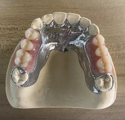 Denti parziali in metallo colato ad alta resistenza con stampa 3D