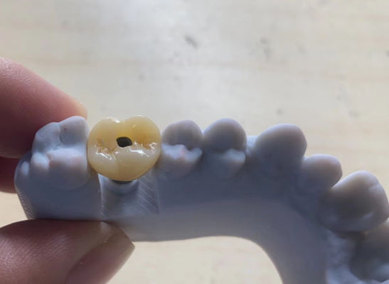 Impianto ad alta precisione con corona supportata Stabile e facile da mantenere