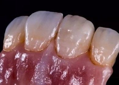 German Amanjilbach Zirconia Dental Crown Alta densità con personalizzazione