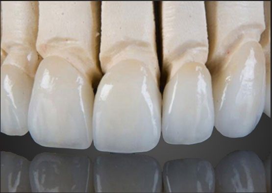 Wieland Zirconia All Ceramic Crown Interior Painting personalizzato con CAD Design