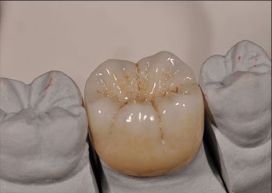 Alta estetica Noritake Zirconia Colore naturale Stabile per la corona completa di zirconia