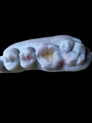 Naturale Traslucido Tutto Ceramico Dental Emax Onlay Per La Restaurazione Dentale