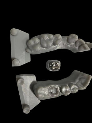 Colonne metalliche resistenti alla corrosione e adesione elevata al nucleo per la restaurazione dentale