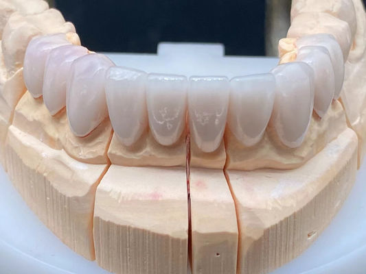 Laboratorio dentale E Max Corona ceramica ad alta trasparenza resistente alla corrosione