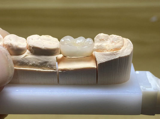 Resistenza alle macchie PFM Corona ceramica regolabile con forma naturale del dente