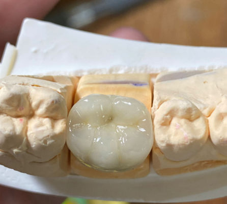 Precise estetica forte dentale PFM porcellana fusa a corona di metallo in odontoiatria