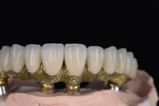 Corone di porcellana naturale fusa in metallo ad alta precisione per impianti dentali