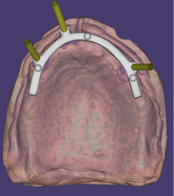 Disegno CAD CAM dentale personalizzato ad alta precisione per l'implant supported bar