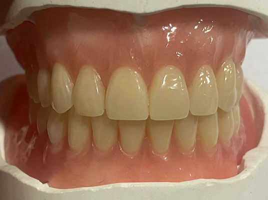 Protesi parziale rimovibile personalizzata ipoallergenica con colore gomma rosa