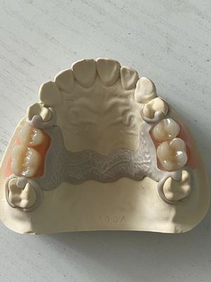Dental PEEK acrilico parziale regolabile con adattamento sicuro