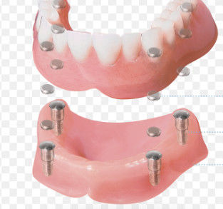 Alte precisioni per l'attacco magnetico dentale, lucidatura superficiale e personalizzazione