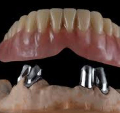 Confortevoli corone telescopiche di facile manutenzione personalizzate per il restauro dentale