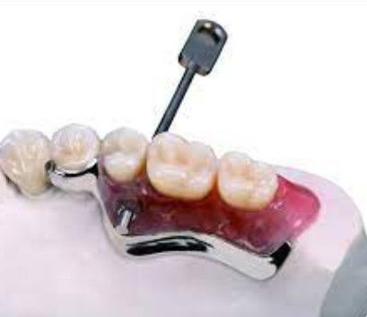 Facile installazione chiave e chiavetta attacco dentale resistente all'ossidazione