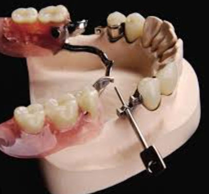 Adattazione dentale regolabile Mk1 resistente all'acqua con acciaio inossidabile